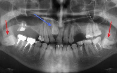 Зубы мудрости: за и против