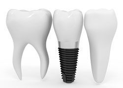 Имплантация зубов: процедуры, технологии, достоинства и риски