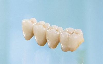 Коронка или имплант: что выбрать?
